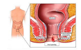 Fissure Treatment in Ahmedabad
