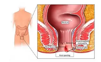 Fissure Treatment in Ahmedabad