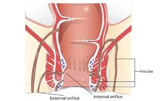 Fistula Treatment in Ahmedabad