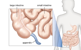 Appendix Surgery in Ahmedabad