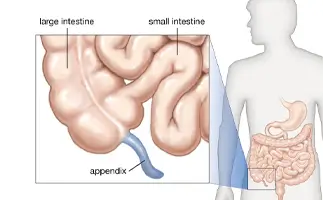 Appendix Surgery in Ahmedabad
