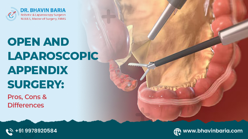 Open and Laparoscopic Appendix Surgery: Pros, Cons & Differences