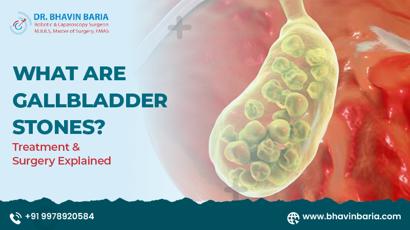 What Are Gallbladder Stones? Treatment & Surgery Explained