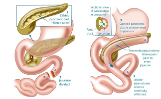 Pancreatic Surgery in Ahmedabad