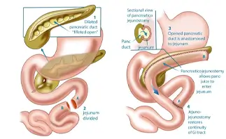 Pancreatic Surgery in Ahmedabad