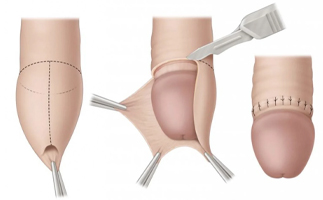 Circumcision in Ahmedabad