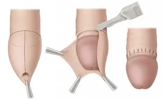 Circumcision in Ahmedabad