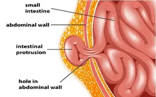 Hernia Surgery in Ahmedabad
