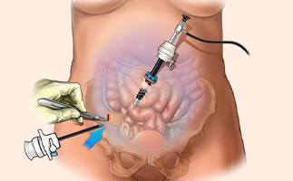 Laparoscopy Surgery in Ahmedabad