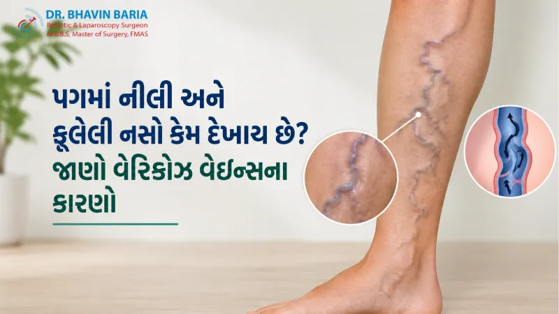 પગમાં નીલી અને ફૂલેલી નસો કેમ દેખાય છે? જાણો વેરિકોઝ વેઇન્સના કારણો