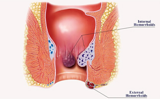 Piles Treatment in Ahmedabad