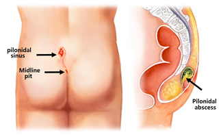 Pilonidal Sinus Surgery in Ahmedabad