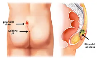 Pilonidal Sinus Surgery in Ahmedabad