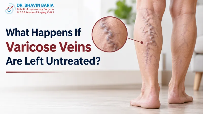 What Happens If Varicose Veins Are Left Untreated?