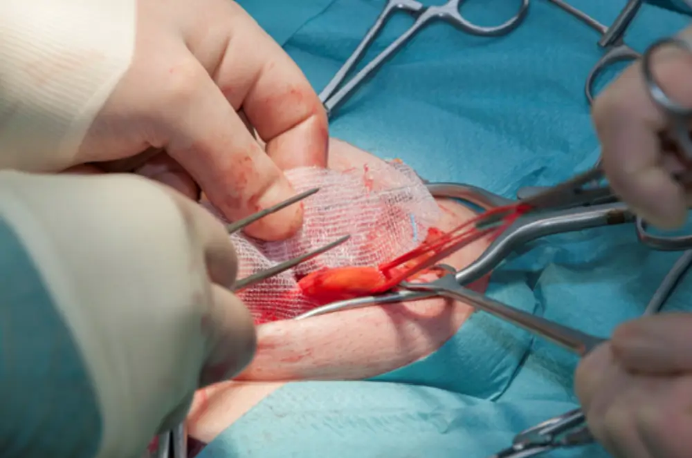 Suffering from Hernia? Explore Safe & Effective Surgery Options for Lasting Relief