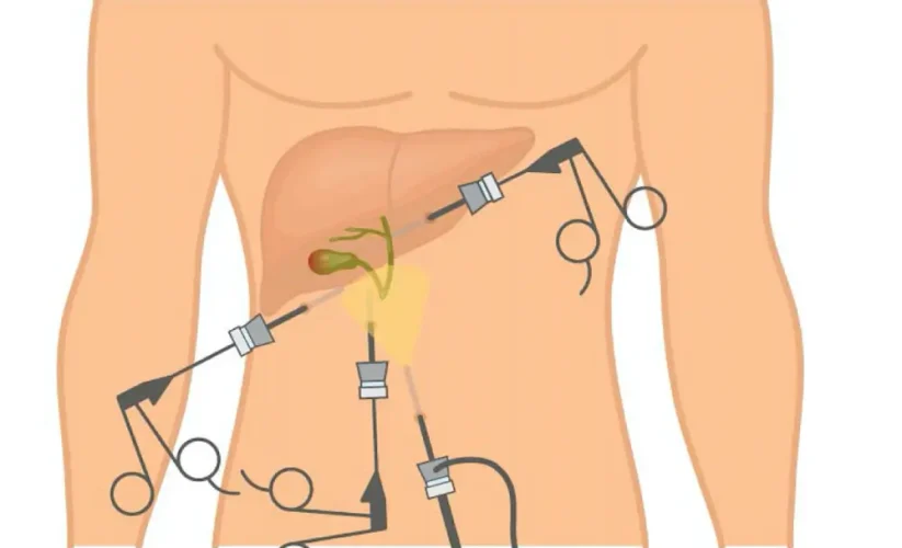 Tired of Gallbladder Stone Pain? Learn How Advanced Surgery Can Help You Recover