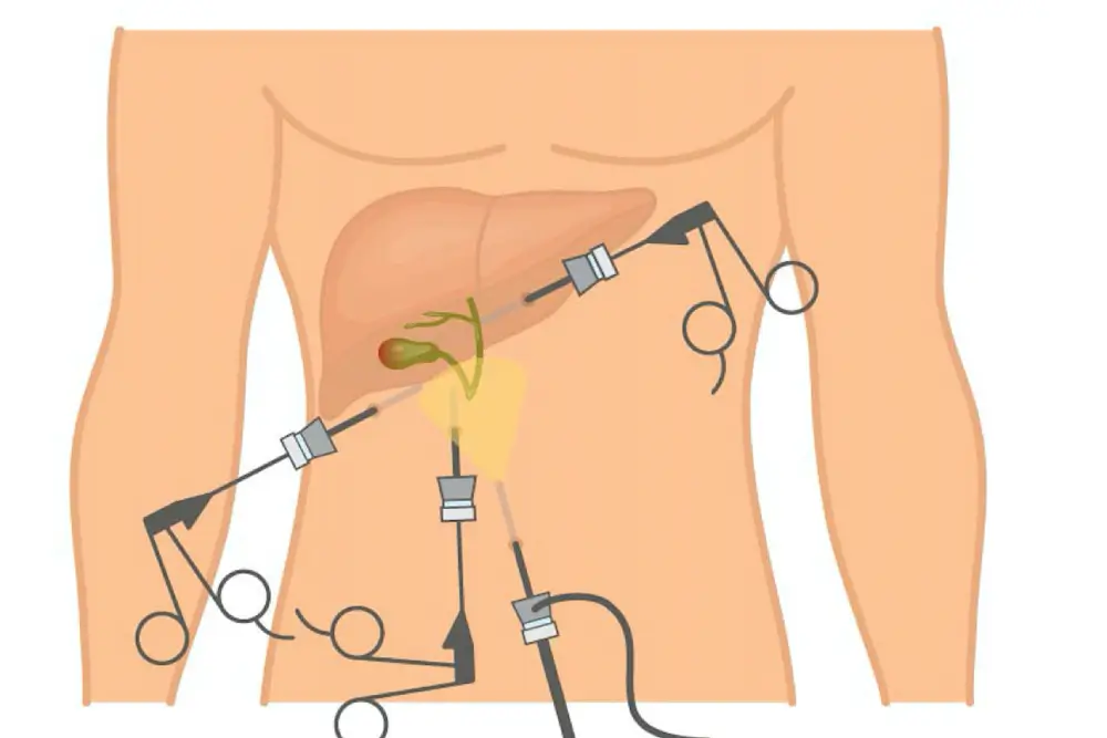 Tired of Gallbladder Stone Pain? Learn How Advanced Surgery Can Help You Recover