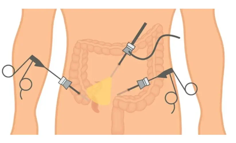 When Does Appendix Pain Become Dangerous? Discover How Surgery Helps