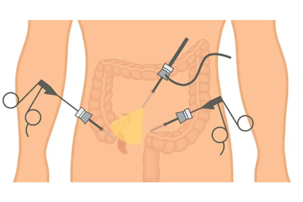 When Does Appendix Pain Become Dangerous? Discover How Surgery Helps