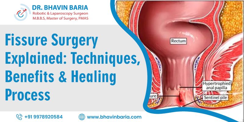 Fissure Surgery Explained: Techniques, Benefits & Healing Process