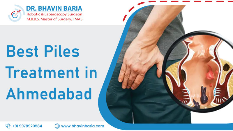 Best Piles Treatment in Ahmedabad
