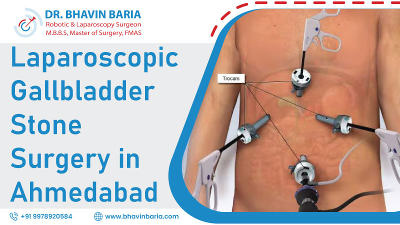 Laparoscopic Gallbladder Stone Surgery in Ahmedabad