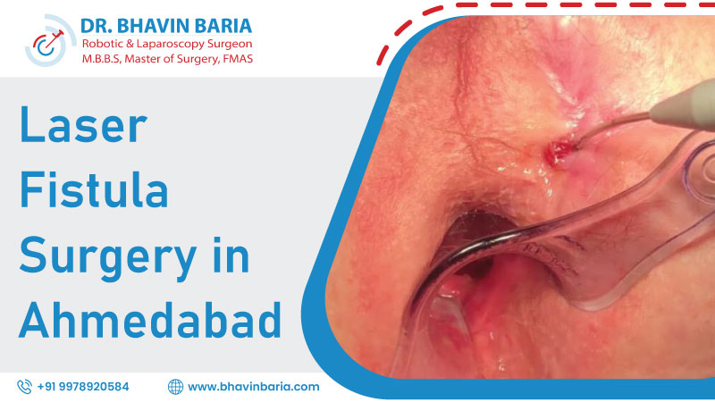 Laser Fistula Surgery in Ahmedabad