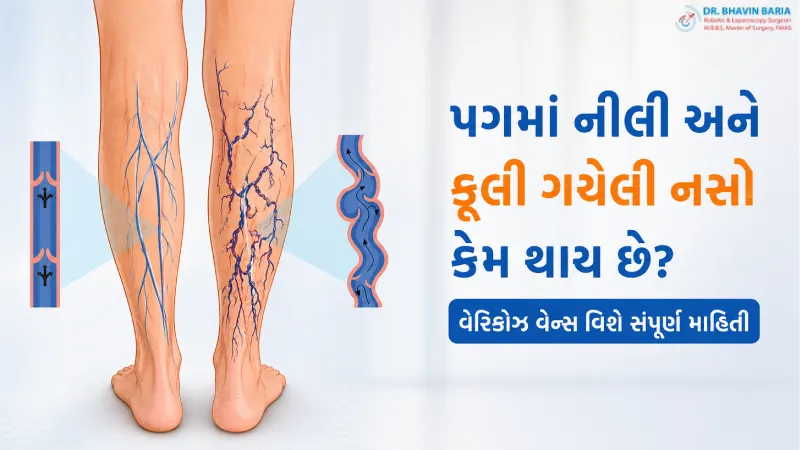 પગમાં નીલી અને ફૂલી ગયેલી નસો કેમ થાય છે? વેરીકોઝ વેન્સ વિશે સંપૂર્ણ માહિતી