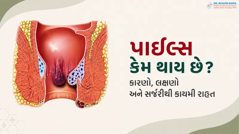 પાઇલ્સ કેમ થાય છે? કારણો, લક્ષણો અને સર્જરીથી કાયમી રાહત